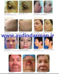 بهترین تولید کننده لیزر CO2 پیکسل